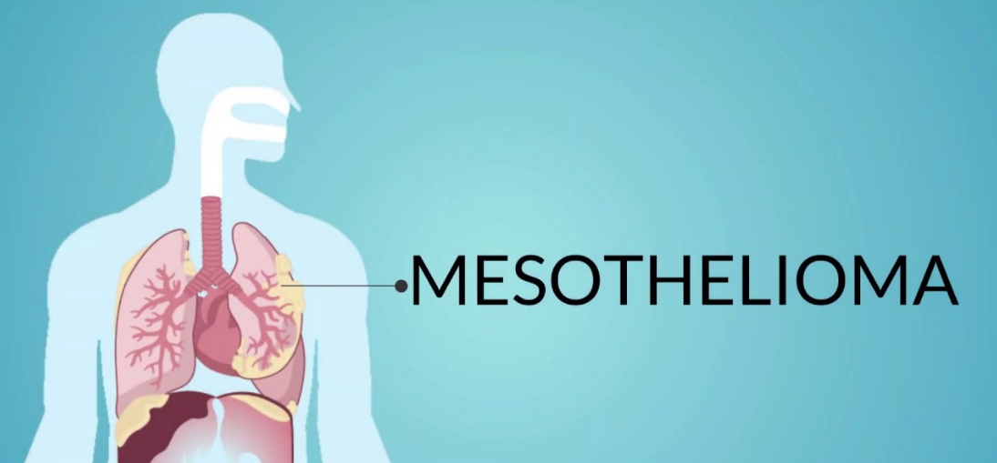 mesothelioma causes