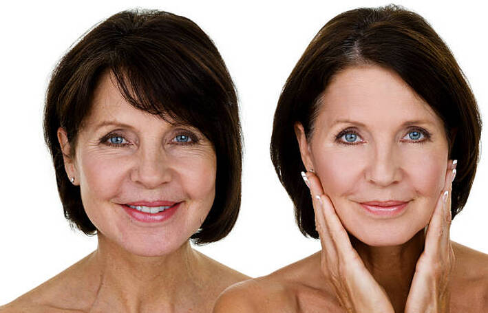Facial Liposuction and Facelift